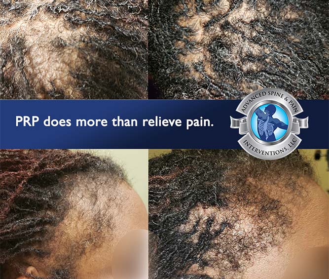 PRP for Hairloss | ATLANTA PAIN SPECIALIST | DR. WOODLEY B. MARDY-DAVIS